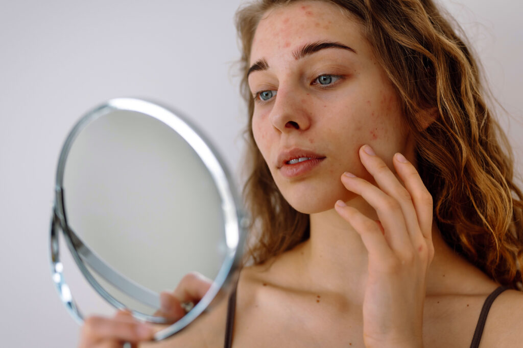 pele-na-menstruação-o-que-acontece