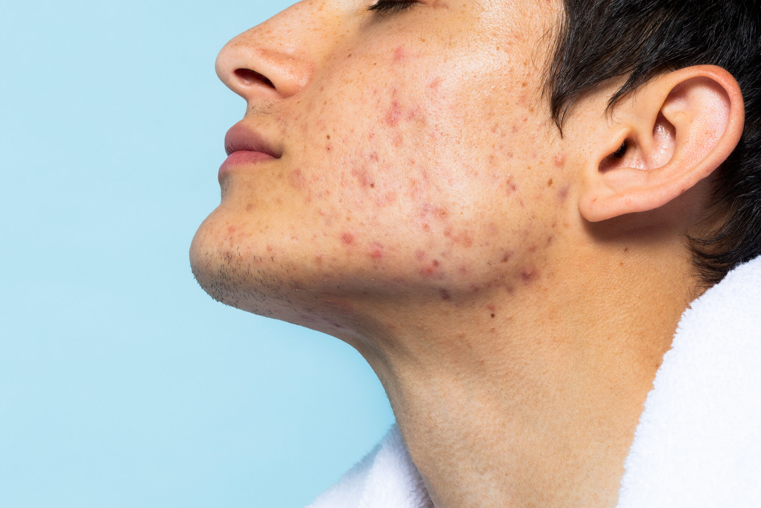 Acne na adolescência: por que ela surge e como deve ser tratada