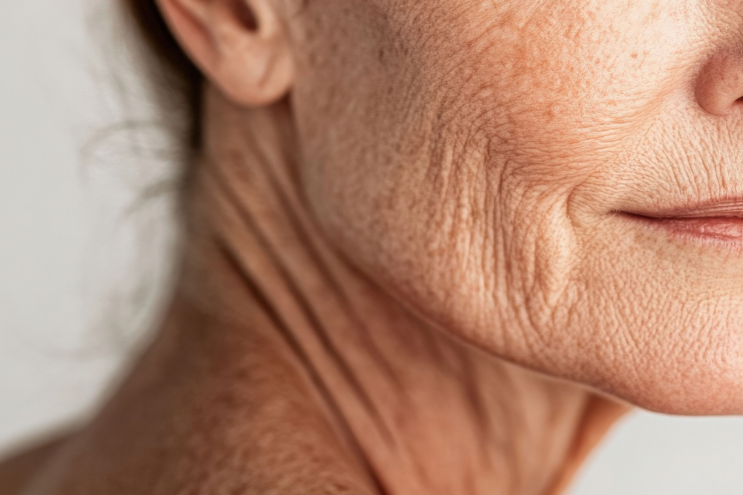 Fotoenvelhecimento – Além das Queimaduras Solares