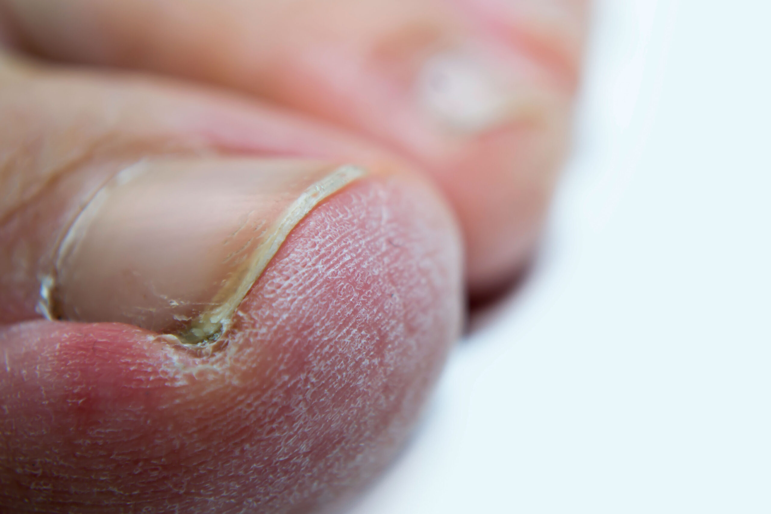 Tratamento De Unha Encravada: Como Aliviar A Dor E Evitar Complicações